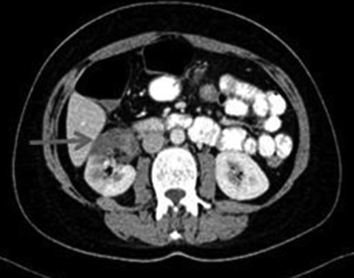 XV. ULUSAL ROMATOLOJİ KONGRESİ Diğer Abstract:0226 PP-115 KRONİK RENAL ENFARK VE NORMAL FERRİTİN DEĞERİ OLAN, ADULT S STİLL HASTALIĞI OLGUSU Şengül Aksakal, Refik Ali Sarı Karadeniz Teknik