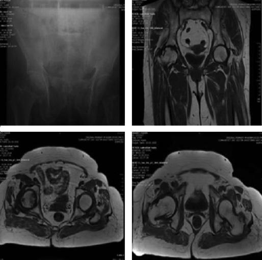 XV. ULUSAL ROMATOLOJİ KONGRESİ Romatoid Artrit Abstract:0233 PP-122 AVASKÜLER NEKROZ VE KO-MORBİDİTELERİ OLAN ROMATOİD ARTRİT OLGUSU Ali Şahin 1, Mustafa Asım Gedikli 2, Doğan Seven 2, Derya Seven 3,