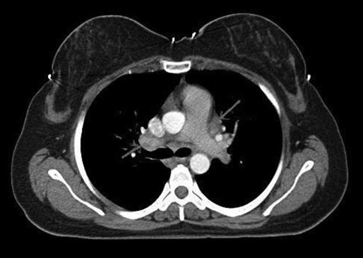 29 Ekim - 2 Kasım 2014 Belek, Antalya tiroid sintigrafisinde diffüz olarak radyoaktif iyot tutulumu saptandı.