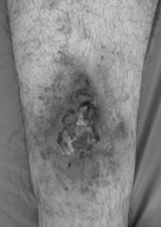 XV. ULUSAL ROMATOLOJİ KONGRESİ Sonuç: Sarkoidoz, birçok primer romatolojik hastalıkları taklit edebilir ve/veya birlikte görülebilir.