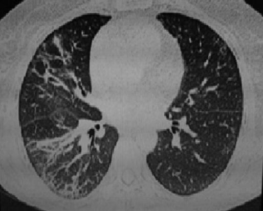 XV. ULUSAL ROMATOLOJİ KONGRESİ Sistemik Lupus Eritematozus, Anti-fosfolipid Sendromu, Skleroderma, Sjögren Sendromu, Miyozitler, Diğer Bağ Dokusu Hastalıkları Abstract:0221 PP-009 OTOİMMÜN HEPATİT