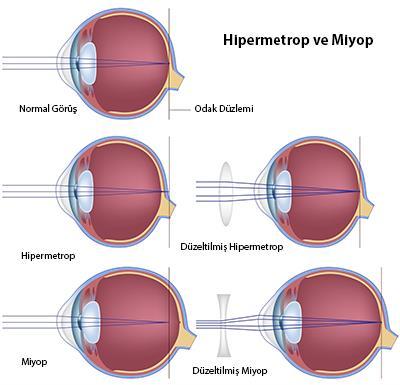 Göz kusurları: Miyopluk: Gözün önden arkaya olan çapının normalden uzun veya göz merceğinin normalden daha şişkin olmasıyla doğan bir kusurdur. Görüntü retinanın önüne düşer. Uzağı iyi göremez.