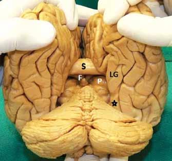 ventrikül atriumunun ön duvarını yapar. Talamusun inferior yüzeyi temporal horn çatısının medial sınırında yerleşmiştir.