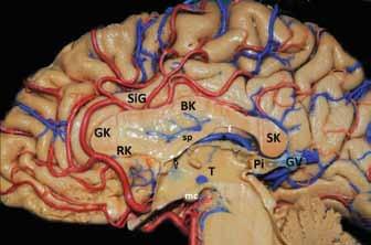 İnternal Kapsül Lateral ventriküle yapılacak cerrahi girişimlerde sıklıkla göz ardı edilen bir bölgedir.