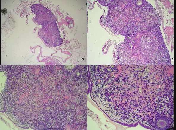 follikül ve/veya kistik folikül görülmemi olması önemlidir. Bu bulgular ovarian stromal hipertrofi ve folliküler geli imde arresti dü ündürmektedir. Resim 8.