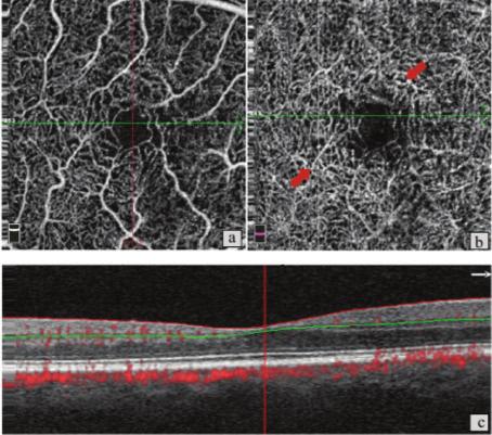 d) OKT de dış retinal tabakalarda belirgin atrofiyle birlikte geniş, skara dönmüş fibrovasküler membran Resim 5. a) Hasta 3, sağ göz.