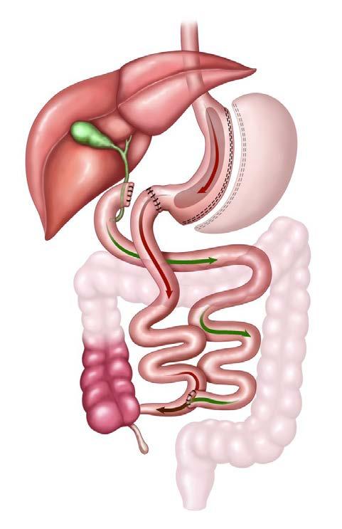 Duodenal