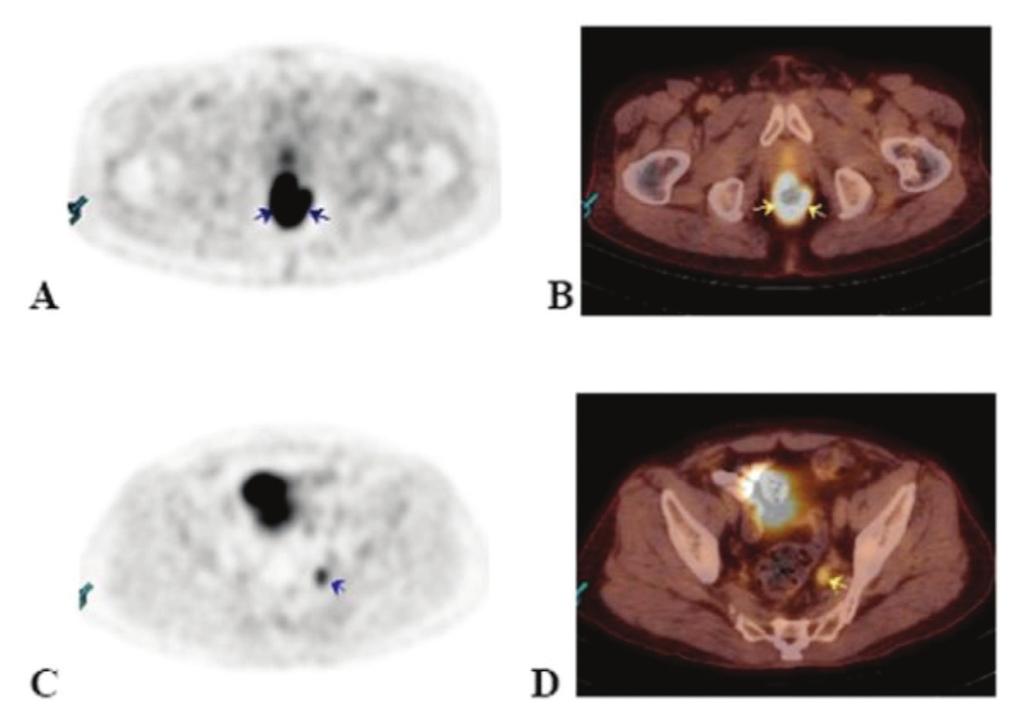 44 primer tümörde ölçülen SUV max değeri ile tümördeki HIF-α ekspresyonu ve diğer patolojik parametreler karşılaştırıldı.