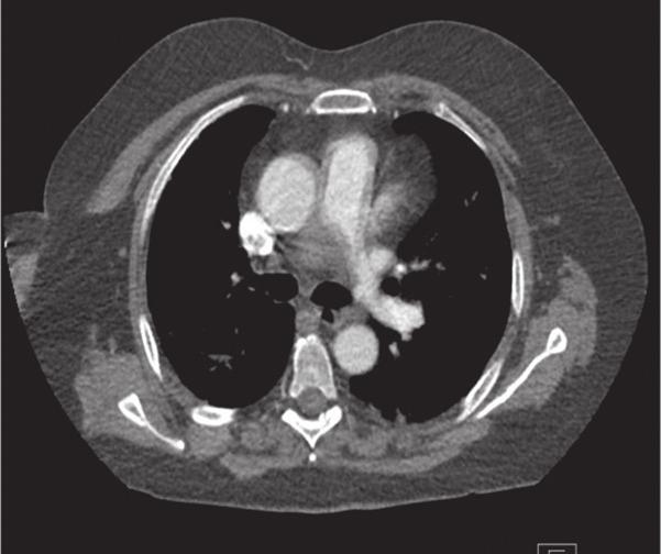 85 torasik aort anevrizması veya diseksiyonu gibi ekstrinsik nedenler veya pulmoner arterin konjenital yokluğu ve Swyer-James sendromu gibi olgular bildirilmiştir.