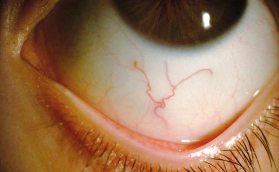 Nilüfer İLHAN ve ark. TABLO 1: Orak hücre anemi ve kontrol grubunda yer alan çocukların EİDGK, sferik eşdeğer ve göz içi basınçlarının sağ ve sol göz için ortalama değerlerinin karşılaştırılması.