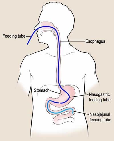 Enteral tüple beslemede yol seçimi Aspirasyon