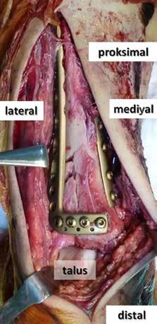Genişletilmiş anterior yaklaşım: Sadece üç basit ekartörün fazla gergin olmadan çekmesiyle, distal tibia metafiz, eklem ve cisminin geniş görüntülenmesi elde edilebilir.