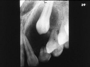 Adenoameloblastoma * Dentijeröz kist, * Ameloblastoma, *