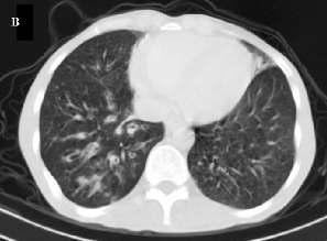 TOMOGRAFİ BULGULARI 6 hastada bilateral retikülonodüler infiltrasyon, 2 hastada buzlu cam görünümü, 2 hastada