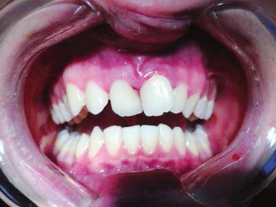 Subluksasyon, diş ve periodontal dokuları etkileyen ve en sık karşılaşılan travma tipidir.