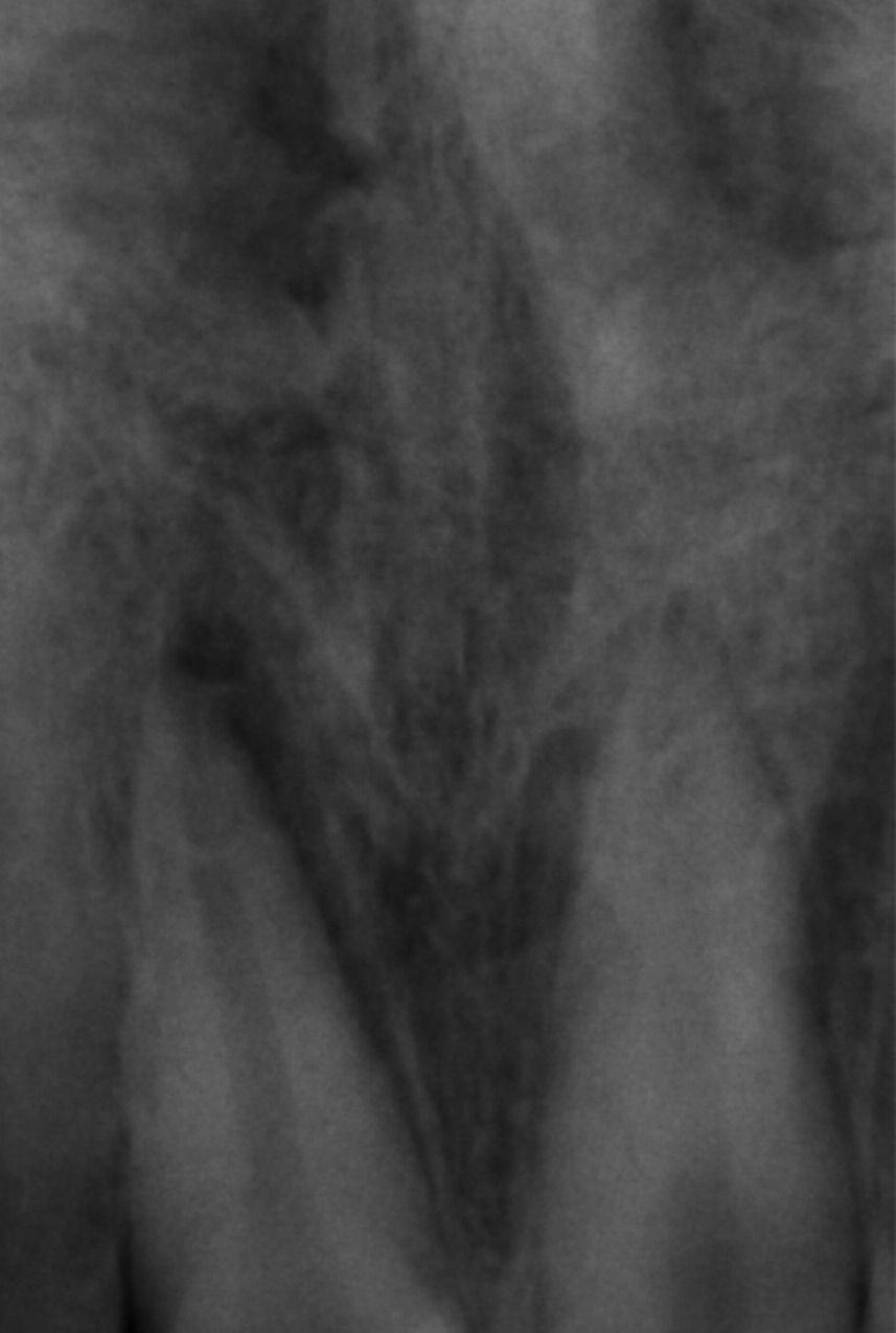 Periapikal radyografide, 11 numaralı lateral luksasyon gösteren dişin soketinde boşluk oluştuğu görüldü.