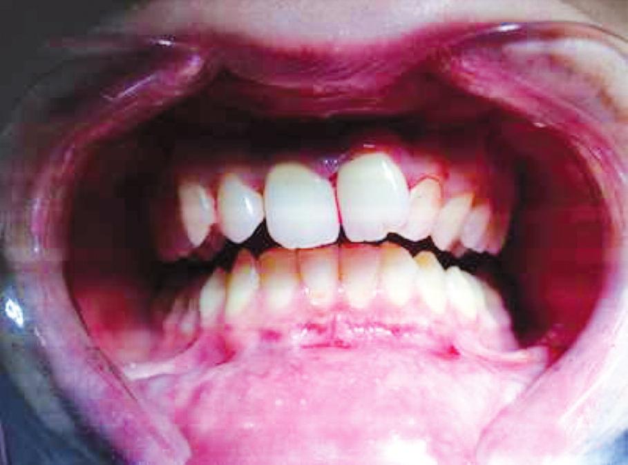 saptanmadı. Sekizinci haftada yapılan vitalite testlerinde dişler yine negatif yanıt verdi.