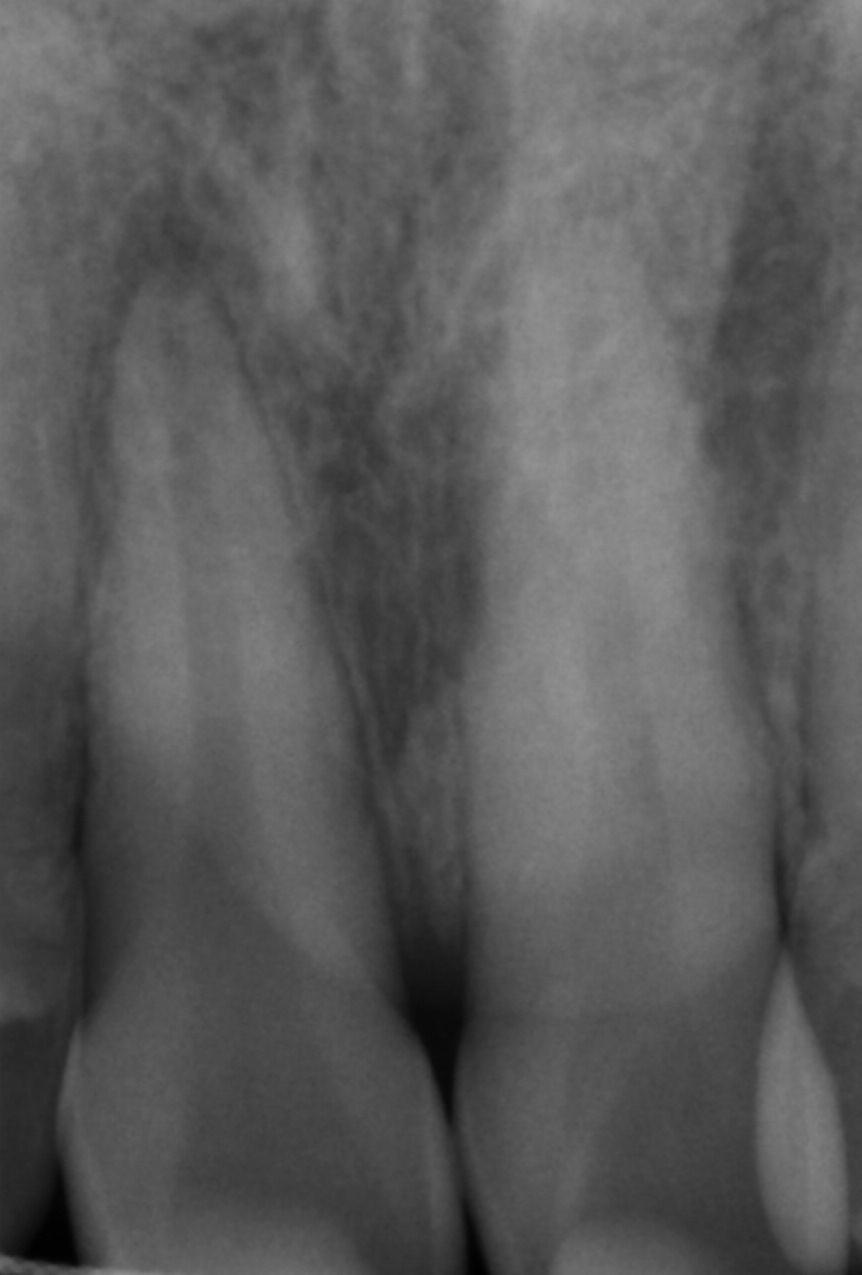 Splint çıkarıldı, dişlerin mobilitesinin normal sınırda olduğu izlendi ve kanal tedavisine başlandı.
