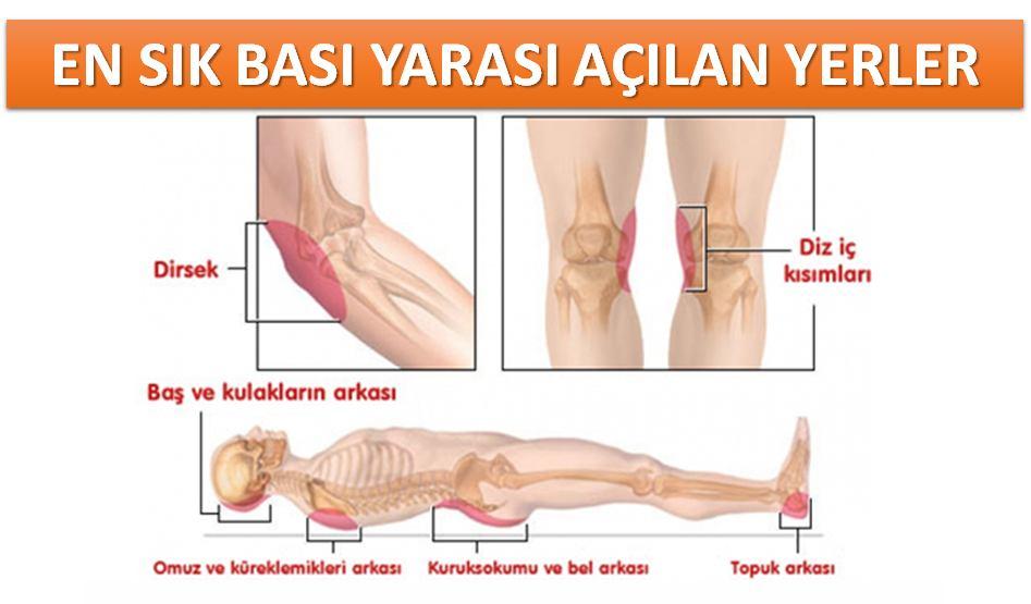 Ülserlerin %63 ü hasta henüz hastanede yatmakta iken gelişmektedir.