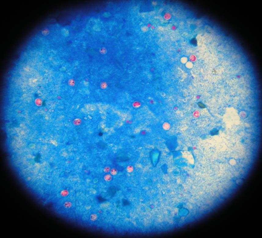 Şekil 10.d: Her alanda 11-100 arası parazit yoğunluğunun boyalı preparat görüntüsü. 4.2.5 Cryptosporidium spp.
