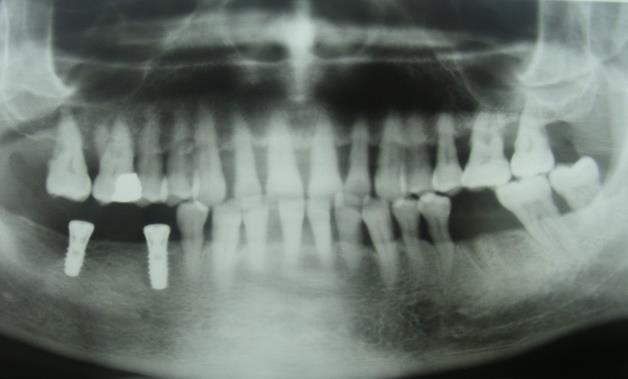 etkileyen diğer faktörler arasında gösterilmektedir [3]. yüzeyi temizliği ve kök yüzeyi düzleştirilmesi işlemleri ile cerrahi olmayan periodontal tedavi uygulandı.