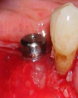 Tablo 1: 45 nolu dental implantın peri-implantitis tedavi öncesi ve sonrası klinik periodontal parametre değerleri Periodontal 45 nolu dental 45