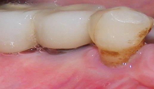 Resim 3: Peri-implantitis tanısı konulan 45 nolu dental implantın tedavi öncesi klinik görüntüsü (A).