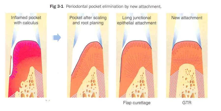 Cep eliminasyonu işlemi sonucu yara iyileşmeleri Enflame cep ve diştaşı Kök düzlemesi ve kürtaj sonrası