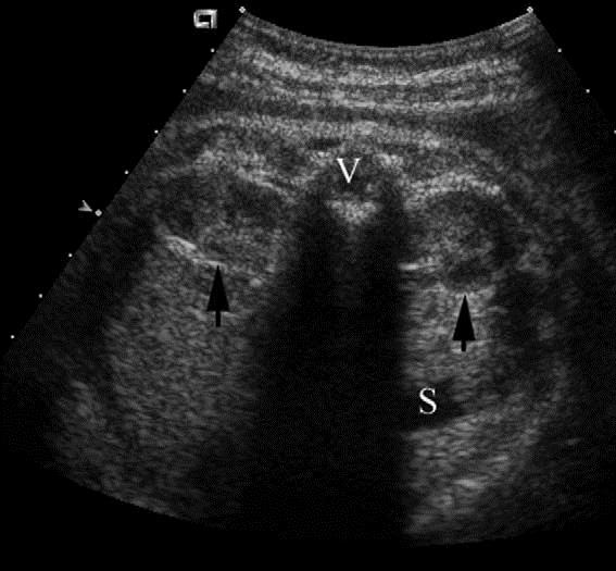 Normal fetal mesane-koronal