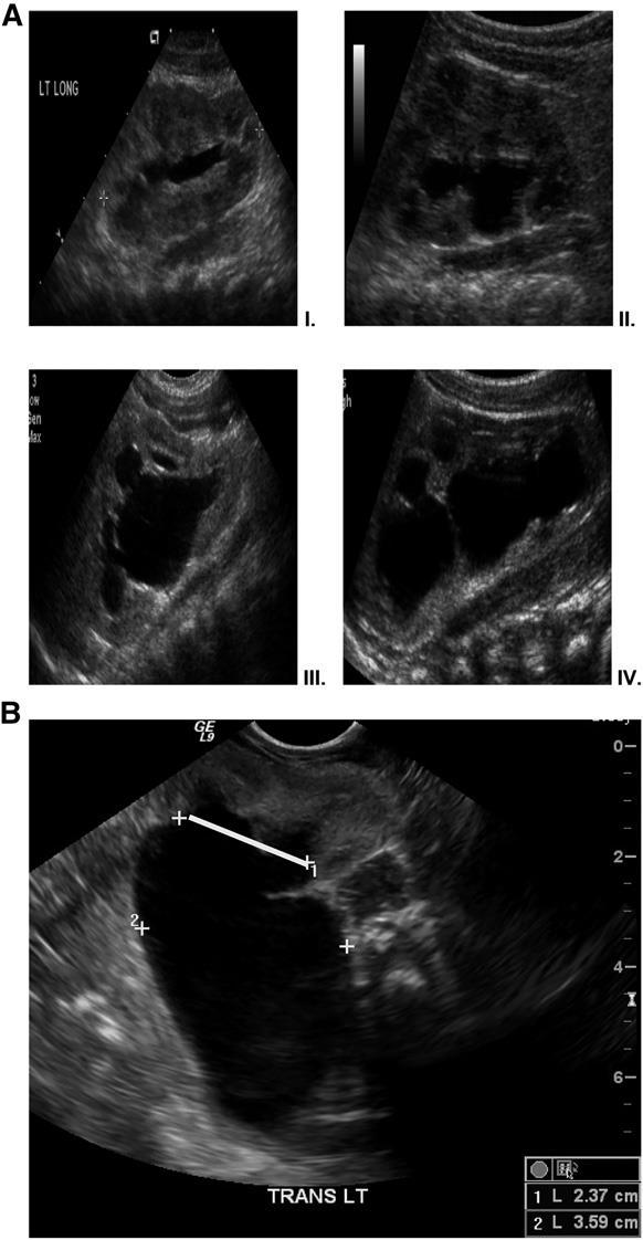 A New Grading System for the Management of Antenatal Hydronephrosis Joana Dos Santos, et all. Clin J Am Soc Nephrol.