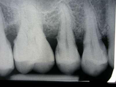 Maksilla molar