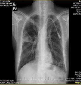 Radyolojik Görüntüleme PA grafisi: Sağ akciğer orta ve üst zonda kama şeklinde infiltrasyon içinde kavite