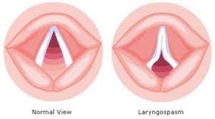 Laringospazm Superior laringeal sinirin uyarılması ile ventilasyonu engelleyecek kadar havayolunun kapanmasıdır. Sekresyonlar ve trakeal tüpün larinksten geçişi provoke edebilir.