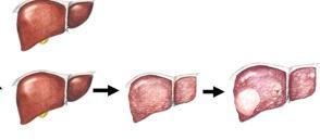 HBV İnfeksiyonunun Seyri %95 Eliminasyon HBV İnfeksiyonu %5 Persistans Nekroinflamatuar