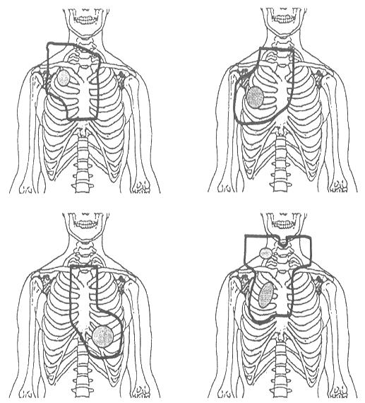 Şekil 4. Konvansiyonel Rayoterapi alanları Çoklu alanlar ve açılı alanlar spinal kord dozunu 45 Gy altında tutarken yeterli tümör dozu sağlarlar.