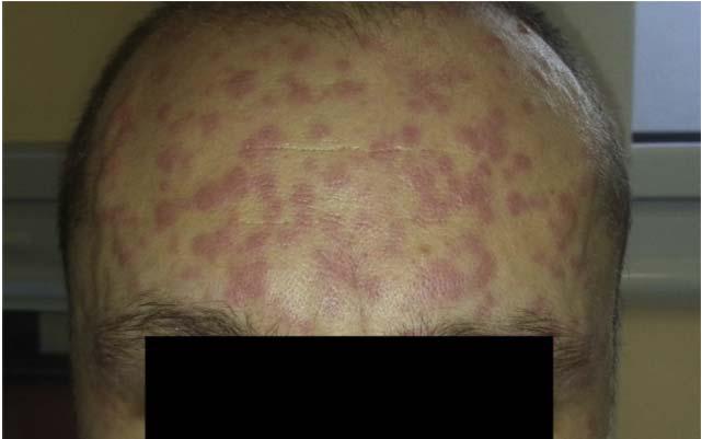 NSAİİ lerin indüklediği Ürtiker & Angioödem NECD (NSAIDs- Exacerbated Cutaneous Disease): NSAİİ lerle alevlenen deri