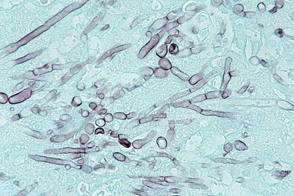 Trikosporinoz Trikosporinoz nadir, ancak mortalitesi