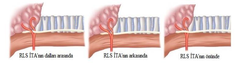 kenarının 1 cm üstünden çaprazlar. Tip II de ise sinir, arteri tiroid polünün <1 cm üzerinden (Tip IIa) veya altından (Tip IIb) çaprazlar ( Şekil 1) (13).
