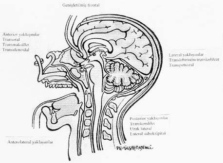 GİRİŞ Foramen magnum tümorleri denildiğinde sadece foramen magnumda sınırlı kalan tümörler dışında juguler bulb seviyesine kadar uzanan ve inferior klivusu da içeren tümörler akla gelmektedir.