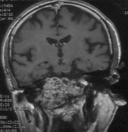 yrıca kraniovertebral bileşke anomalilerinde ve romatoid artritlerde bu bölgeye ulaşım için uzak lateraltransatlas yaklaşım da tarif edilmiştir (17).