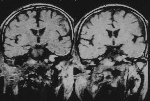 Nörolojik muayenesi intakt olan hastanın eski ve yeni kranial MRI' ları karşılaştırıldığında tümörün zaman içinde klivus arkasından başlayarak foramen magnuma doğru uzandığı