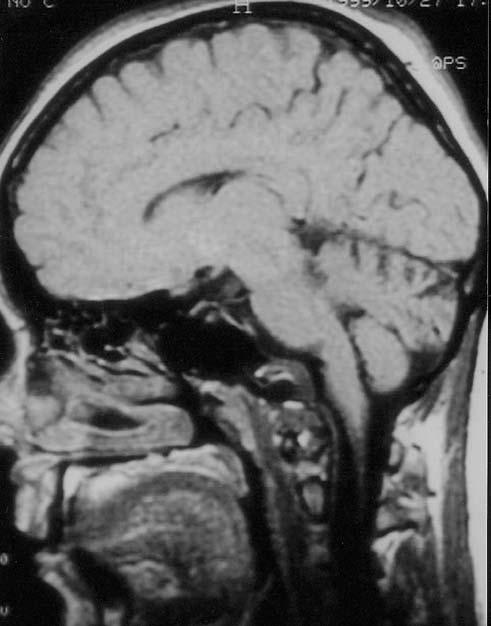 meliyat sonrası hastanın ek nörolojik defisiti olmadı ve kontrol filmleride tümörün total olarak çıkarıldığı  (Şekil 3,4).
