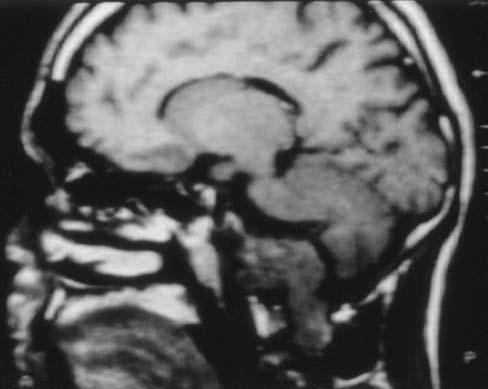 Şekil 5: Foramen magnum lateraline yerleşen ve foramen magnumdan aşağıya doğru uzanım gösteren bir schwannoma olgusunun preoperatif aksiyal () ve sagital () MRI görüntüleri.