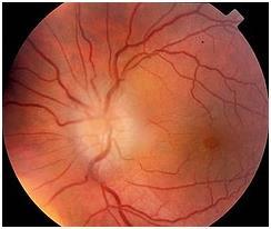 Görme İle İlgili Belirtiler: Optik nöroritis, MS te başlangıç belirtileri arasında sık görülebilen bir belirti olup; bir gözde ani