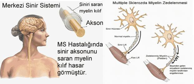 Multiple skleroz (MS); merkezi sinir sistemindeki inflamasyon ve nöronların etrafını saran miyelin