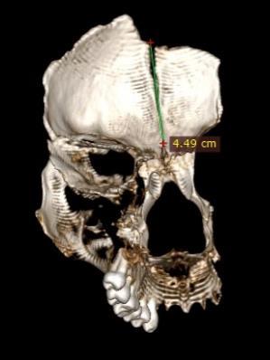 Resim 2: Babacan kadın bireyin metopik sütur anteriör (a) ve inferiör (b) görüntüsü (BT) Kafatası Sinüsleri: Kadın bireyin kafatası sinüslerinin ayrıntılı morfolojisinin tıbbi