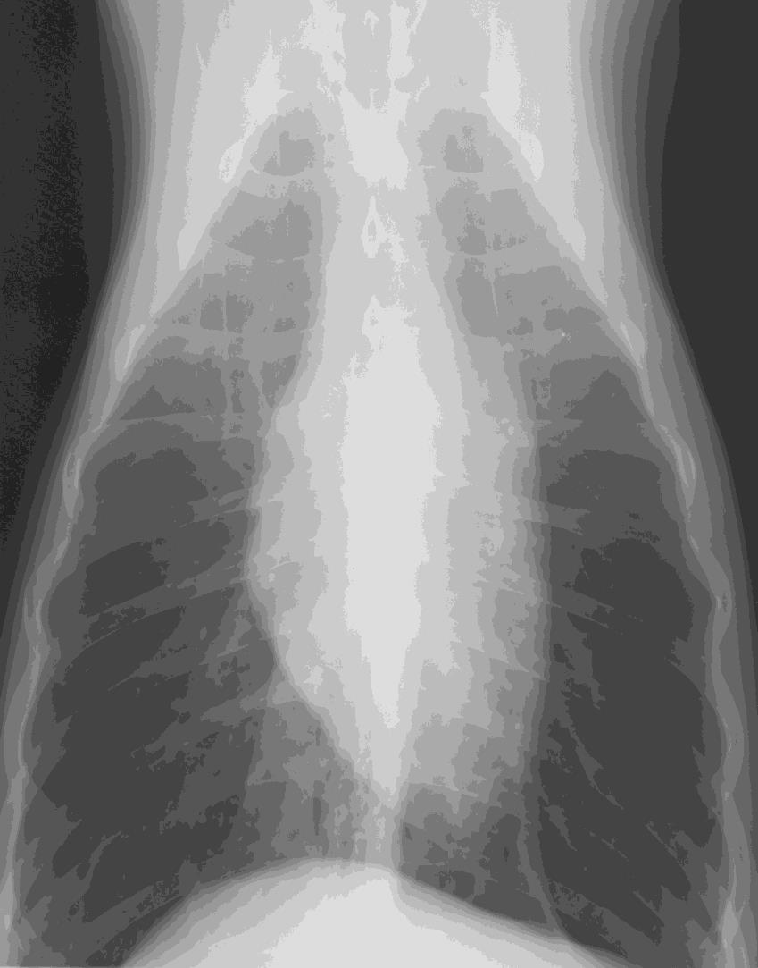 Akciğerlerin Normal Radyografik Anatomisi Sol lop