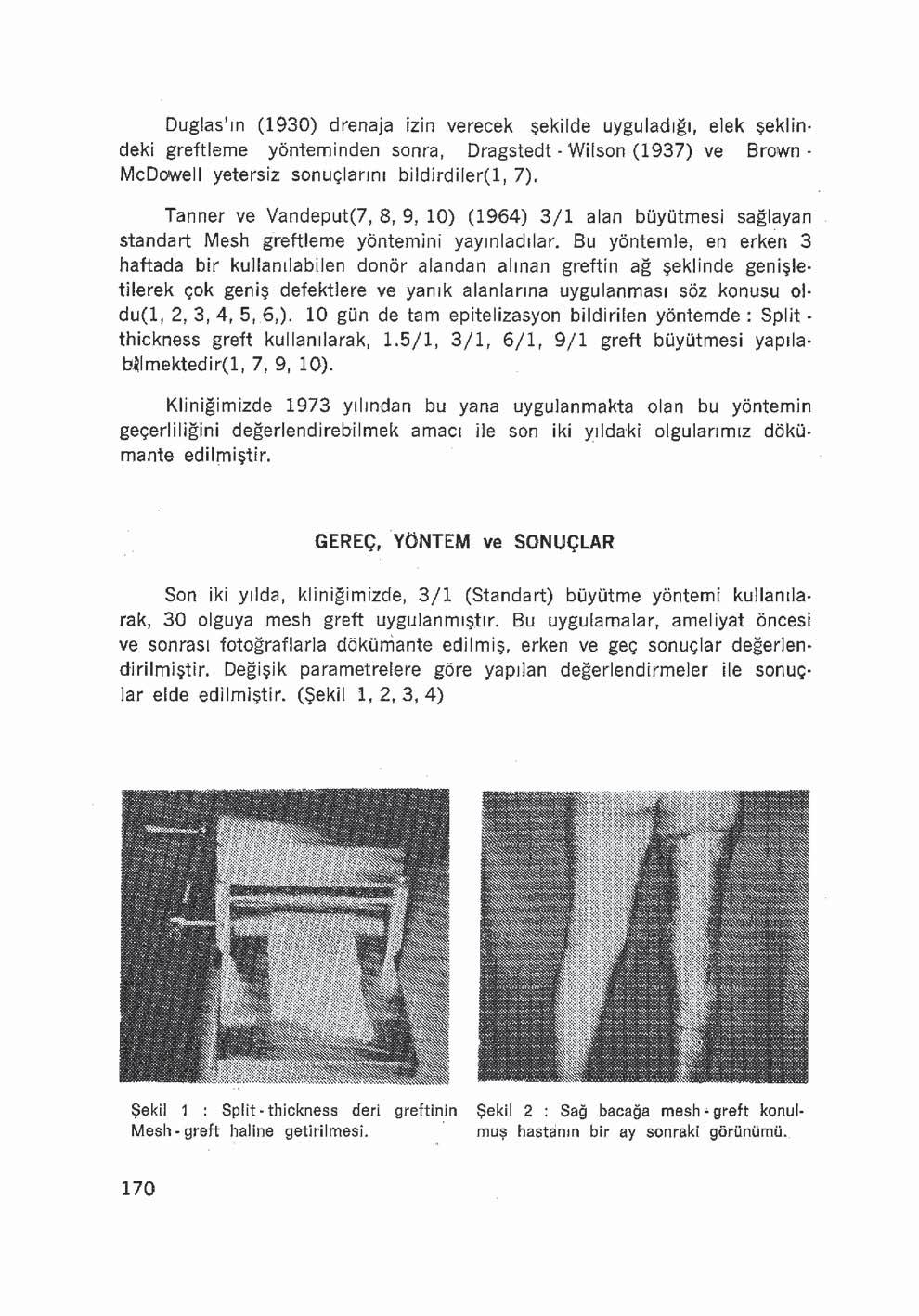 Duglas ın (1930) drenaja izin verecek şekilde uyguladığı, elek şeklindeki greftleme yönteminden sonra, Dragstedt - VVilson (1937) ve Brown- McDowell yetersiz sonuçlarını biîdirdiler(l, 7).