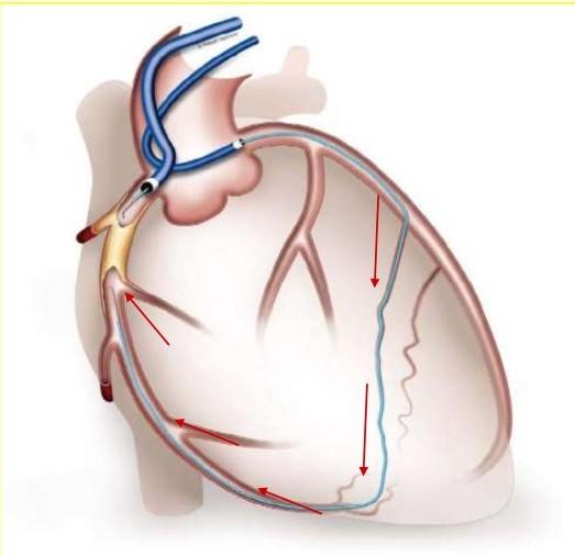 Retrograd Girişimin Yol Haritası Angiografik değerlendirme Kollateral geçiş Darlığın geçilmesi Retrograd telle