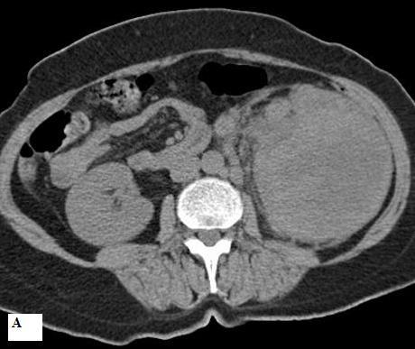 Resim 4: 59 ya nda kad n hastada 15 cm çap nda sarkomatoid renal hücreli karsinom olgusu.